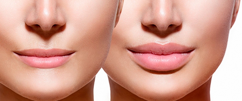 ¿Qué usamos para el aumento de labios?