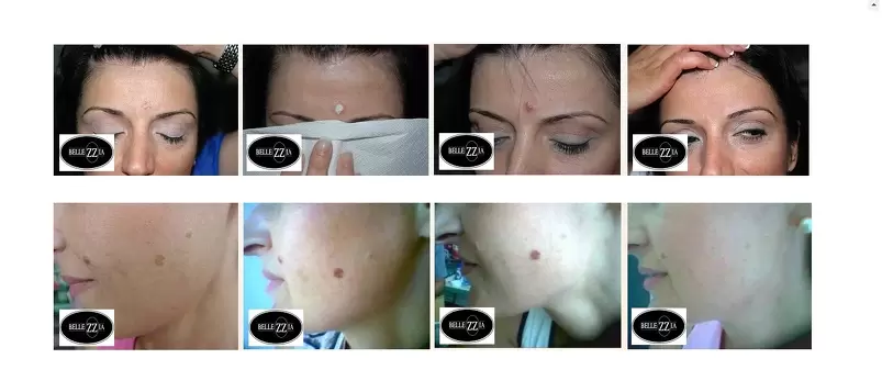 Antes y Después con el tratamiento de Crioterapia Dermatológica