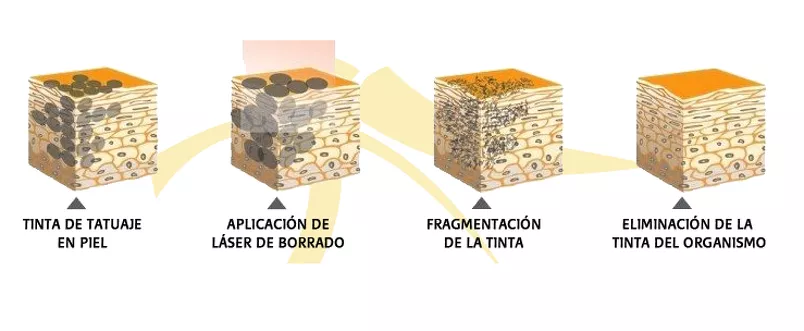 ¿Cómo se realiza el tratamiento?