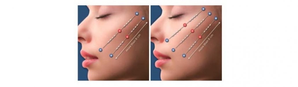 ¿Qué son los hilos tensores faciales?