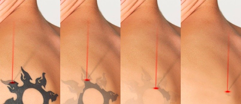 Tipo de tatuaje y localización corporal