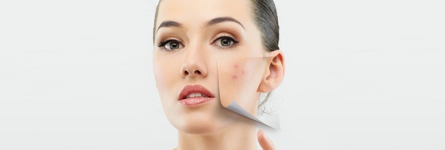 Tratamientos para combatir el acné