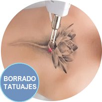 Oferta - Tratamientos Corporal - Eliminación de Tatuajes