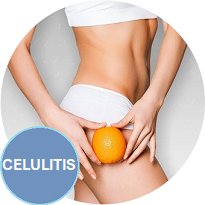  Oferta - Tratamientos Corporales - Celulitis