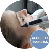 Oferta - Tratamientos Faciales - Accurett Eliminación Manchas