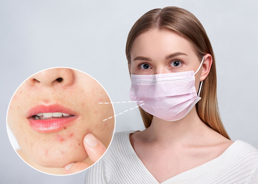 ACNÉ DE MASCARILLA: ¿QUÉ ES MASKNE?  ¿CÓMO PODEMOS COMBATIRLO?